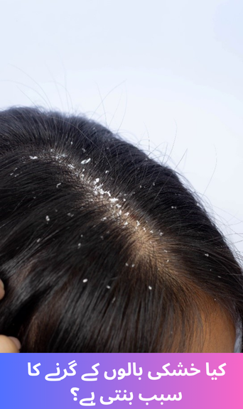 Does dandruff cause hair loss?